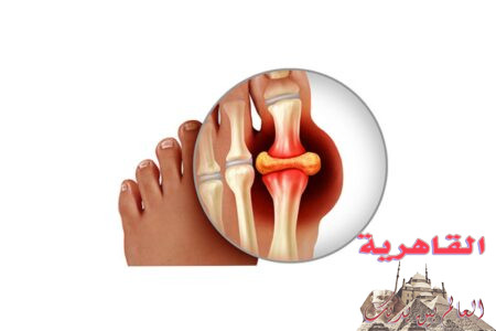 أحذر من الأسباب الرئيسية لمرض النقرس